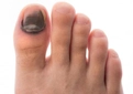 Ayak Tırnağı Morarması Belirtileri ve Tedavisi Ayak Tırnağı Morarması Belirtileri ve Tedavisi