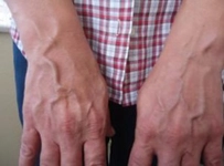 Damarda Morarma Belirtileri ve Tedavisi Damarda Morarma Belirtileri ve Tedavisi