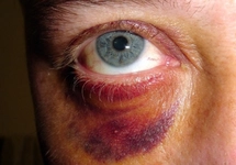 Morarma Nasıl Geçer? Morarma Nasıl Geçer?