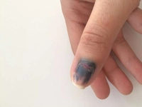 Tırnak Dibi Morarması Belirtileri ve Tedavisi Tırnak Dibi Morarması Belirtileri ve Tedavisi