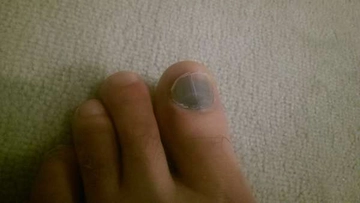 Ayak Baş Parmak Morarması Belirtileri ve Tedavisi Ayak Baş Parmak Morarması Belirtileri ve Tedavisi