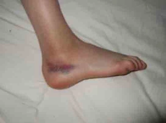 Ayak Bileğinde Morarma Belirtileri ve Tedavisi Ayak Bileğinde Morarma Belirtileri ve Tedavisi