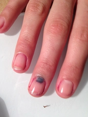 El Tırnak Morarması Belirtileri ve Tedavisi El Tırnak Morarması Belirtileri ve Tedavisi