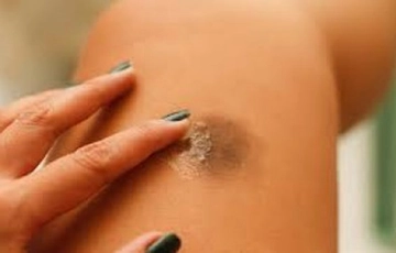 Kaşıntı Sonrası Morarma Belirtileri ve Tedavisi