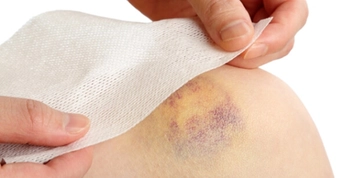 Lösemi Belirtileri Morarma Belirtileri ve Tedavisi Lösemi Belirtileri Morarma Belirtileri ve Tedavisi