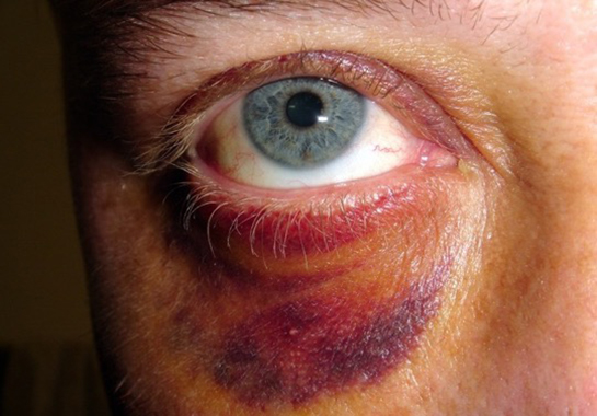 Darbe Sonucu Göz Morarması Nasıl Geçer?